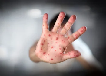 Mil nuevos casos de sarampión se registran en México durante los primeros nueve días de febrero.-